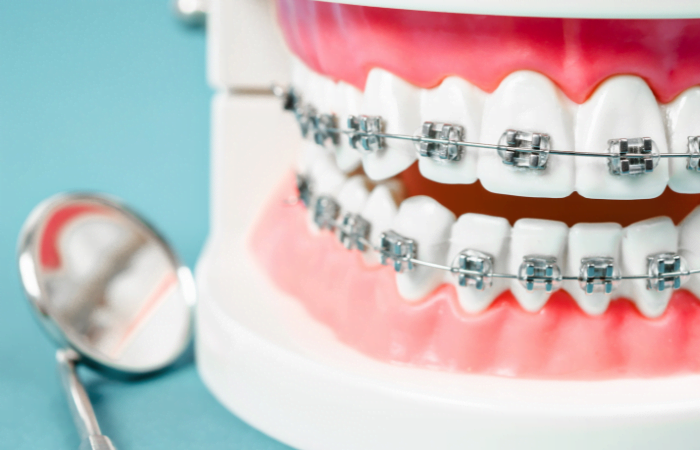 dental braces treatment